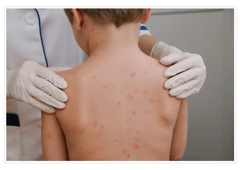 Três casos de meningite viral fazem cidade de MT suspender aulas